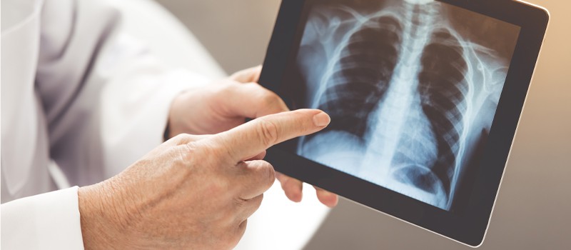 Terapia respiratoria a domicilio en Bogotá con nebulizaciones y oxígeno